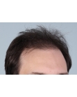 Before Hair Transplant&nbsp;Front